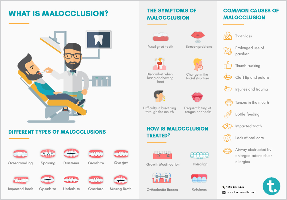 maloclusión de los dientes