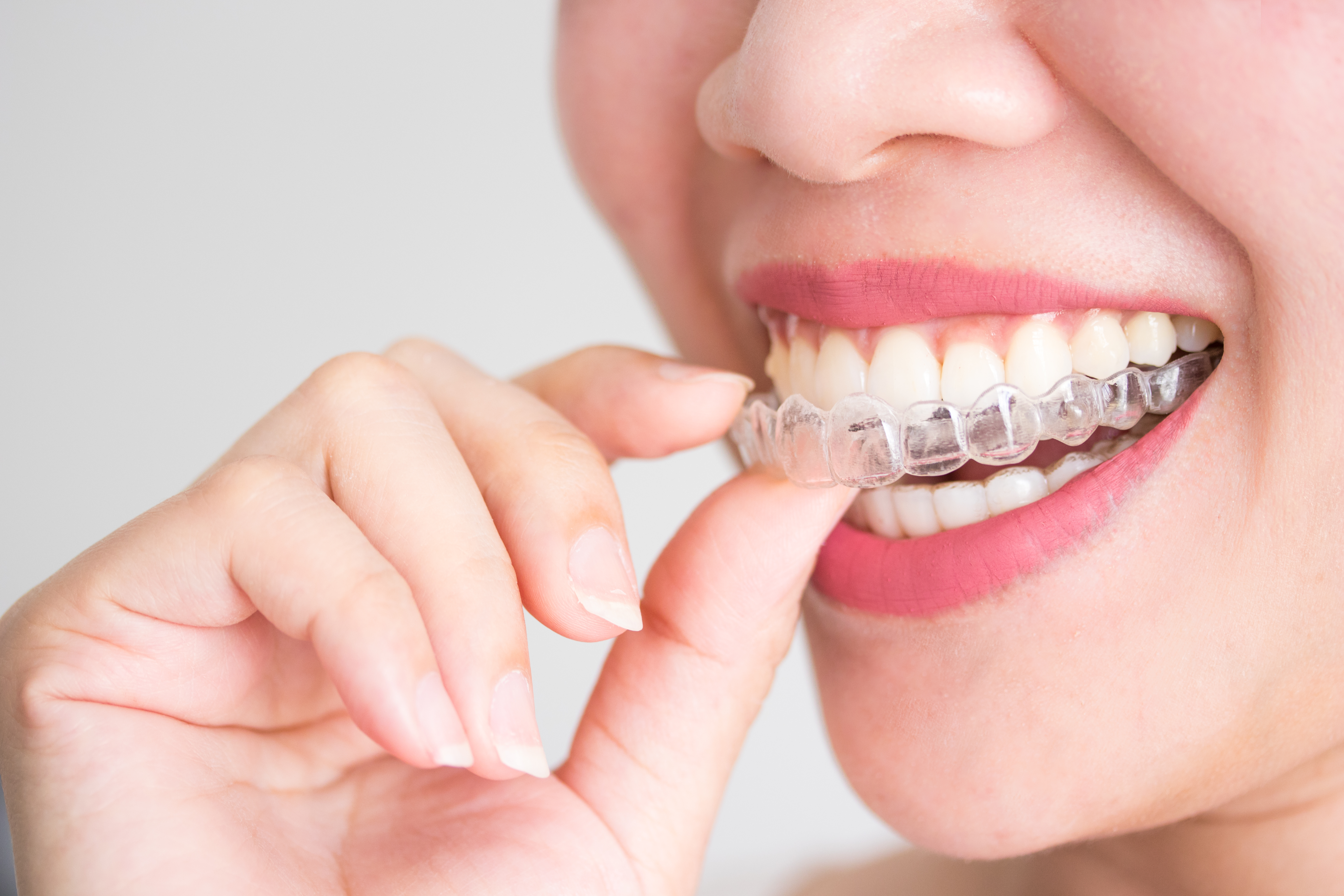Invisalign Gap Between Tray And Teeth - Invisalign Express 2 Months Only To Close Front Gap Passamano Orthodontics / Invisalign is a great alternative to traditional braces to fix your smile.