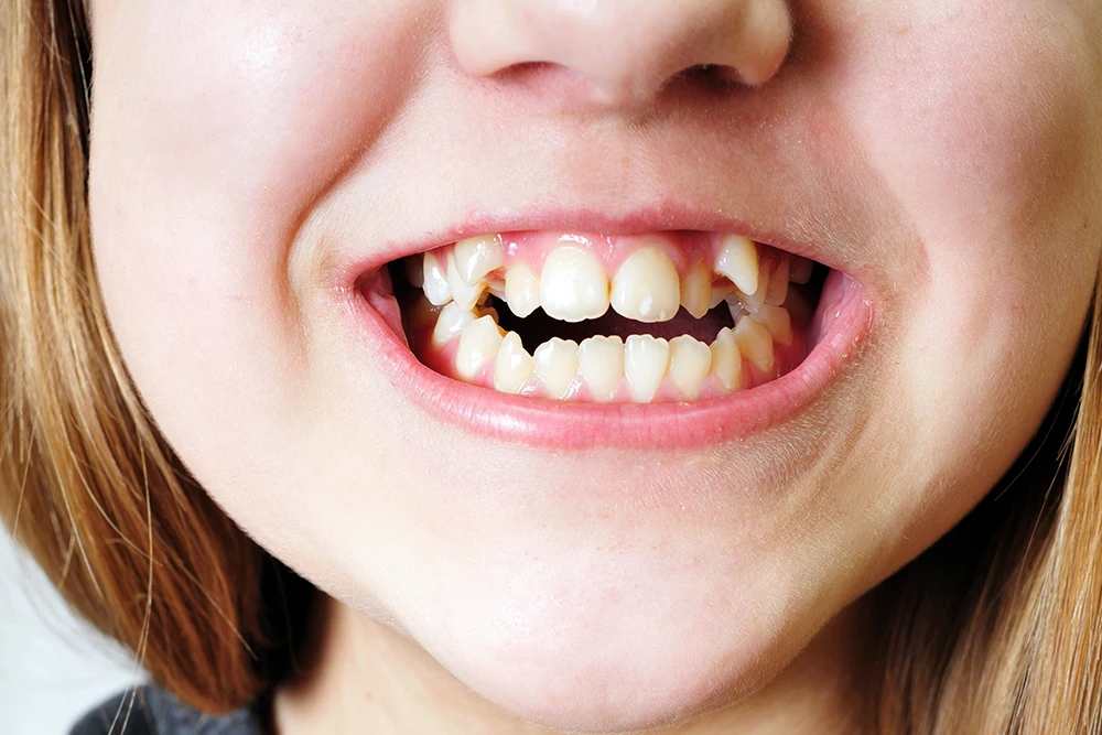 https://www.thurmanortho.com/wp-content/uploads/2018/12/braces-for-crooked-teeth.webp