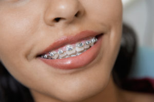 Affordable Braces in Fresno & Clovis