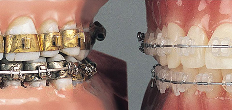 The Interesting History Of Braces Thurman Orthodontics