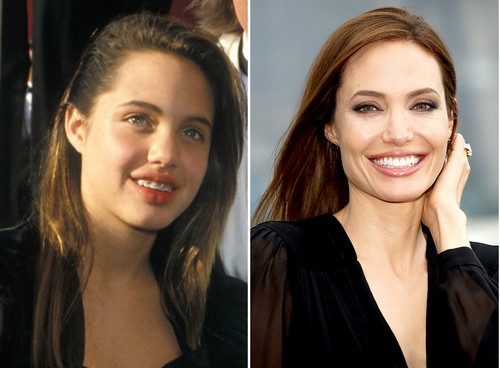 24 Celebrities Who Had Braces