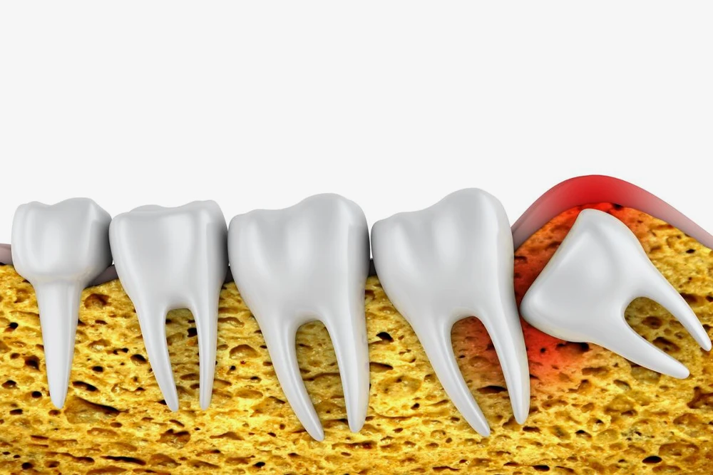 Impacted Wisdom Tooth