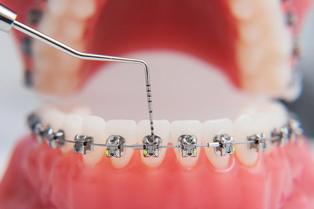 What Happens If You Have Braces And Don't Brush Your Teeth?