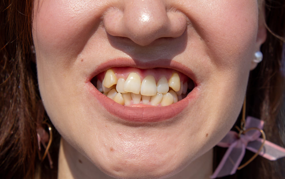 4 Dental Health Problems that can be Fixed by Orthodontic Treatment