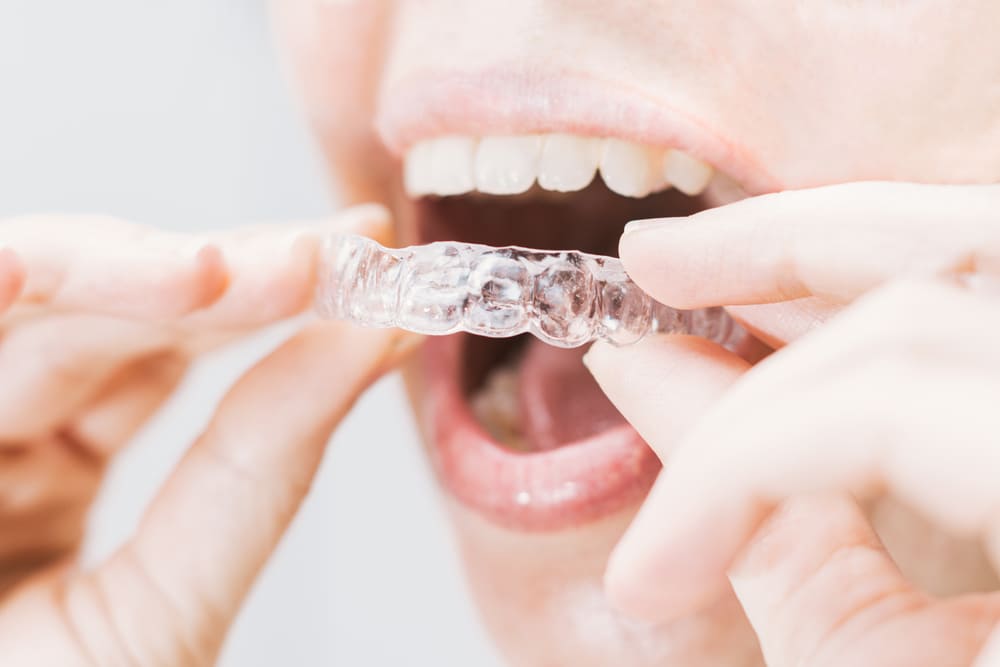 Ways to Bid Farewell to Your Invisalign Pain
