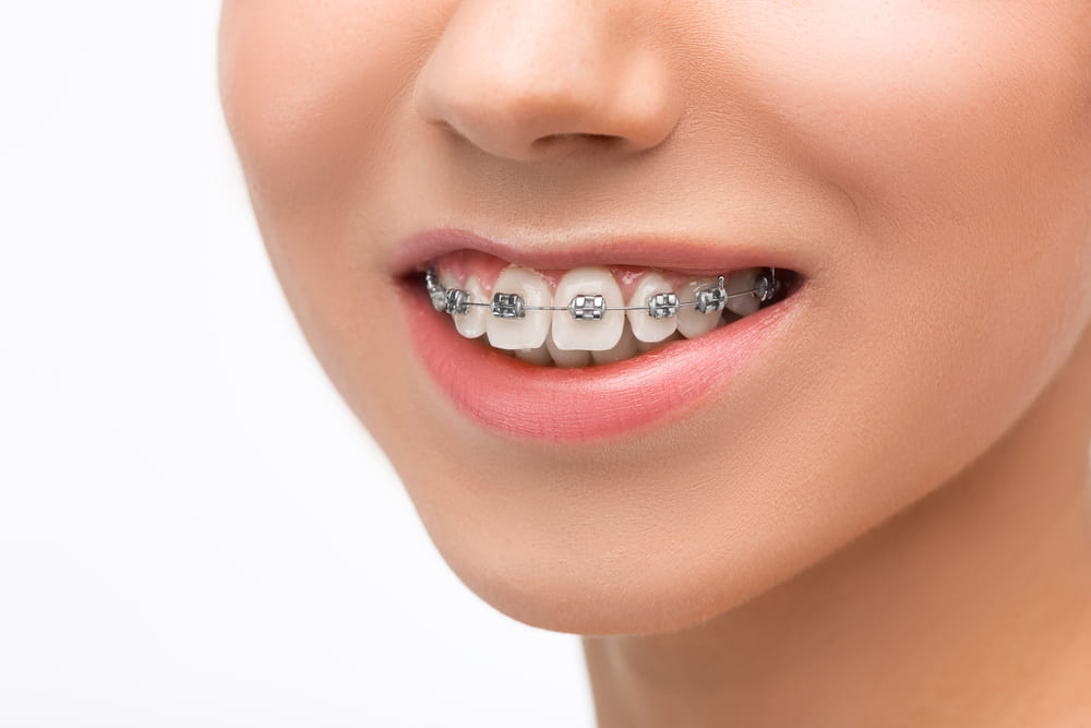 Things to Know Before Getting Braces