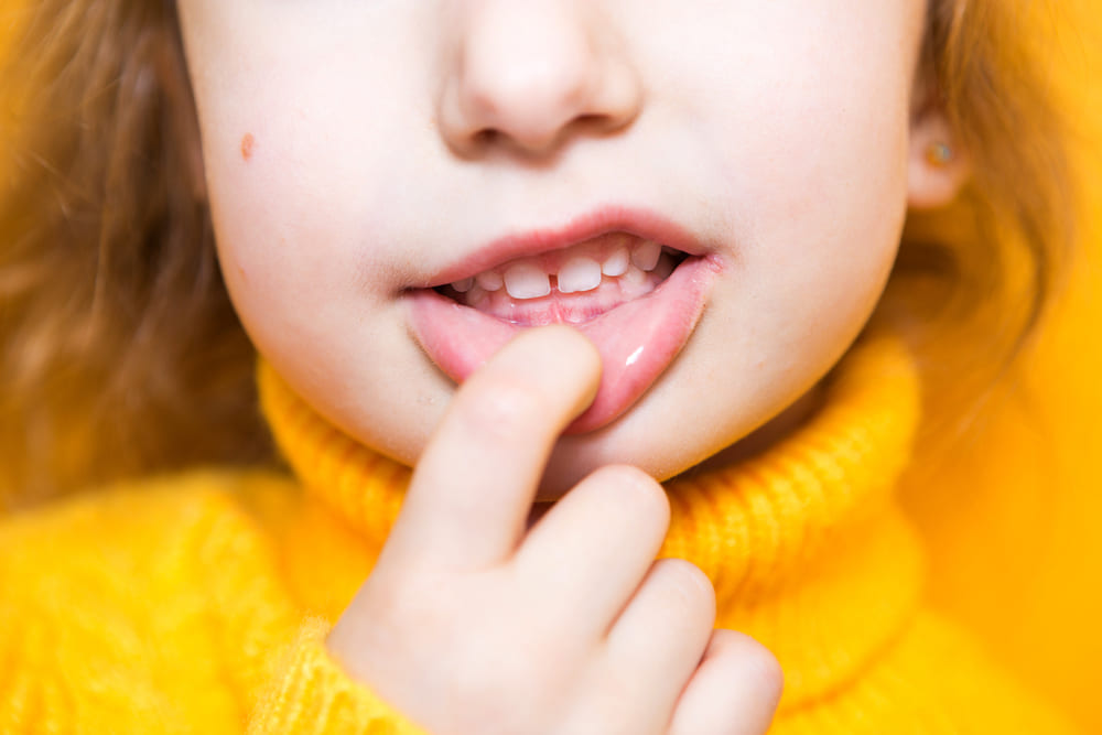 child with overbite (buck teeth)