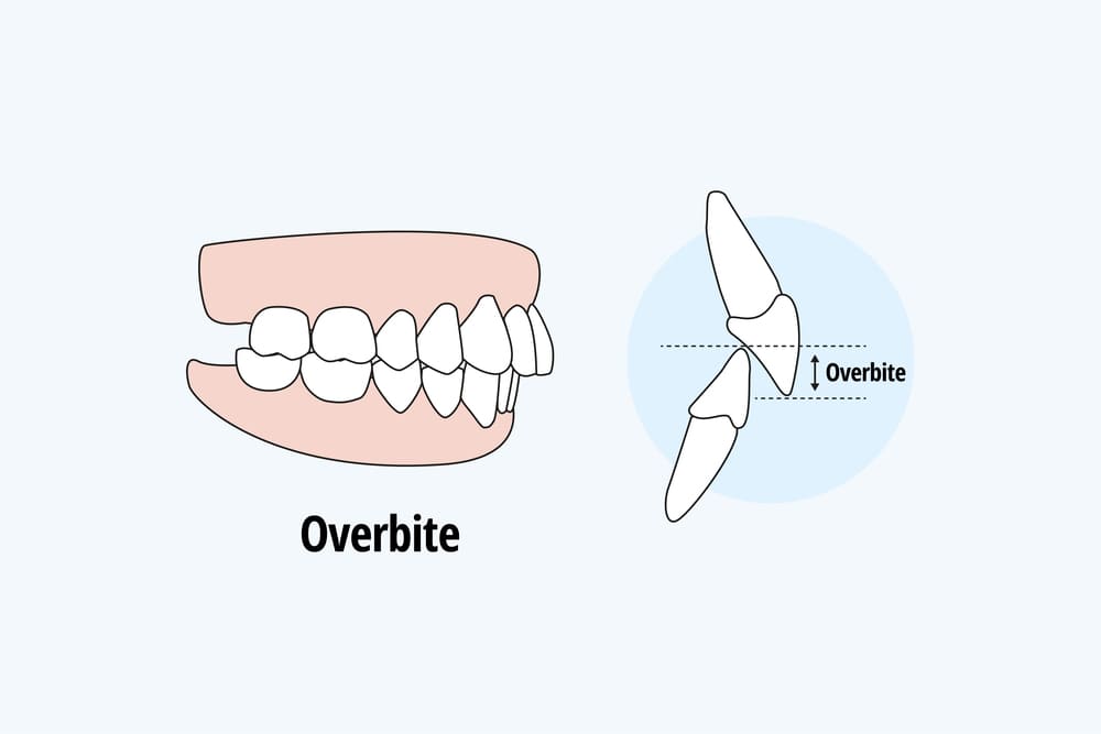 overbite graphical representation
