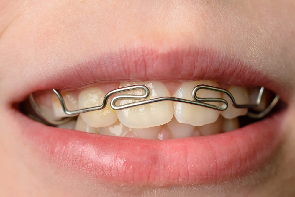 Cracking the Wearing and Caring for Your Retainer Routine