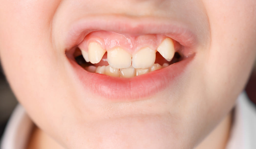 Crooked Teeth in Kids Here’s What You Can Do