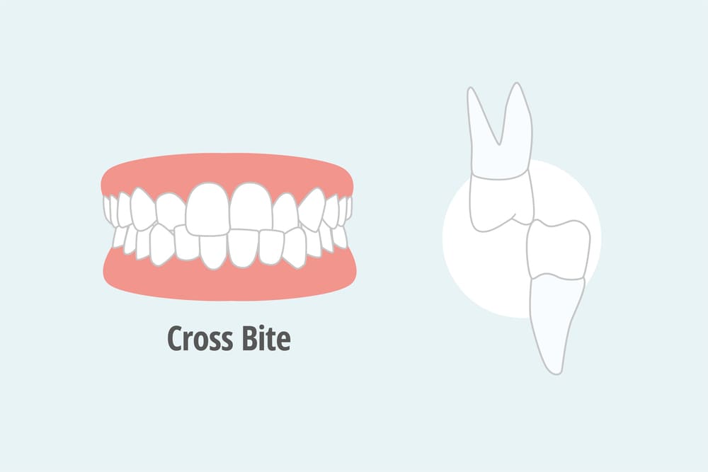 How To Fix a Crossbite Causes and Treatment