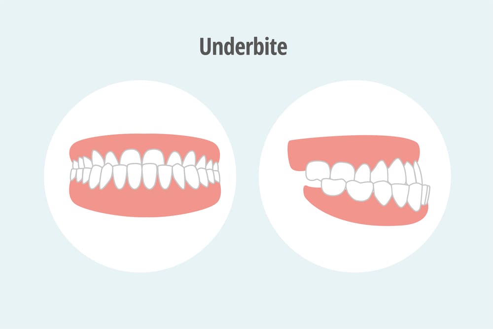 How to Fix an Underbite Causes & Treatments