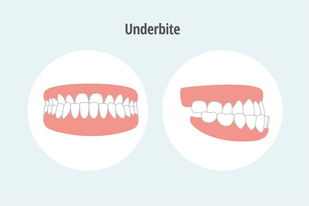 How to Fix an Underbite? Causes & Treatments - Thurman Orthodontics