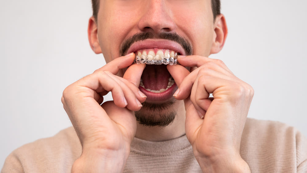 How to Keep Your New Invisalign® Smile