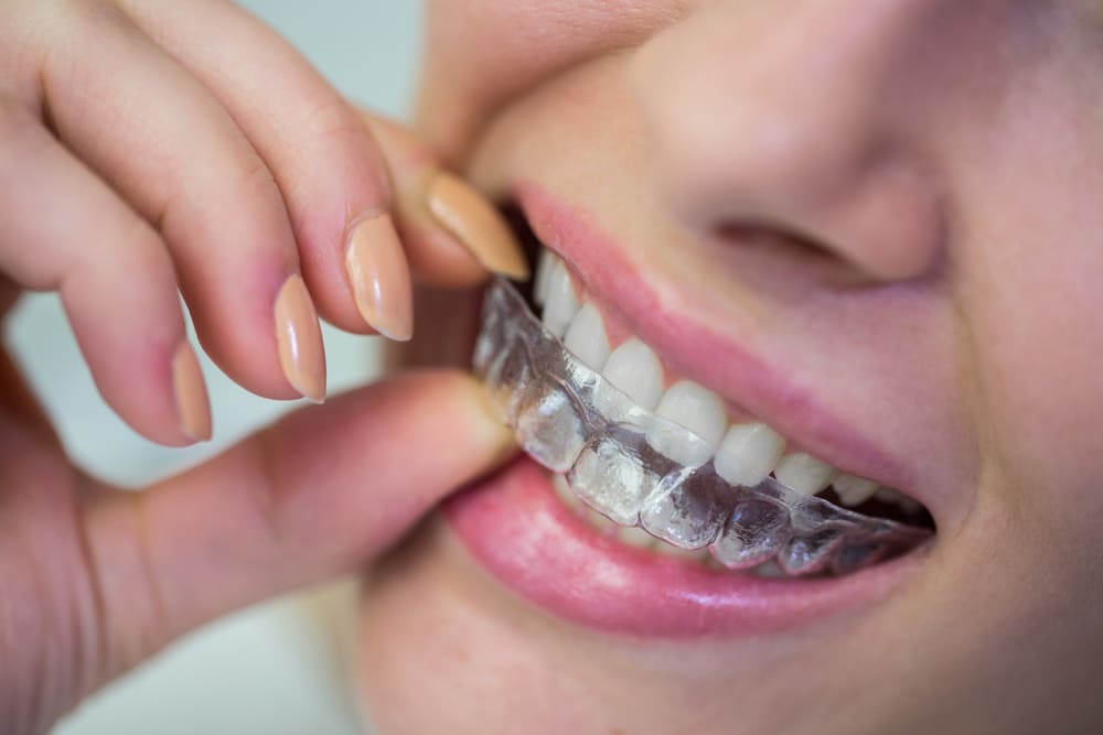 Can Invisalign Fix Overbite - Thurman Orthodontics