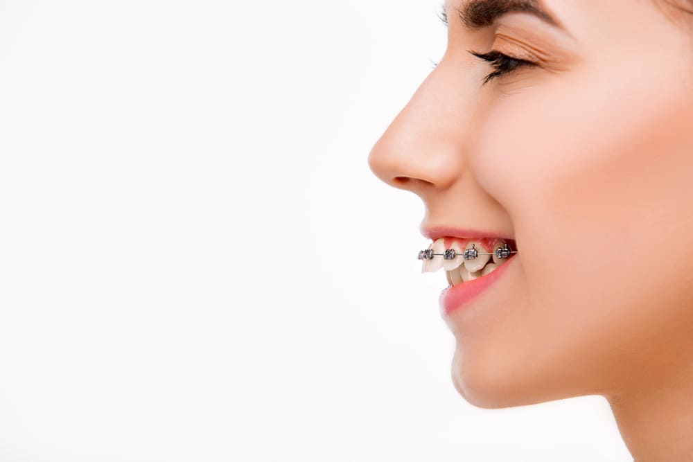 The Interesting History of Braces