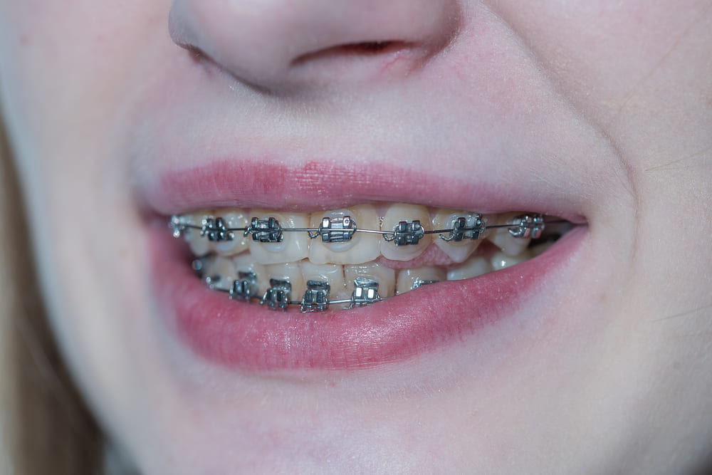 When Does Your Child Need Braces Stop Guessing and Read This