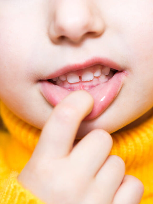 child with overbite (buck teeth)
