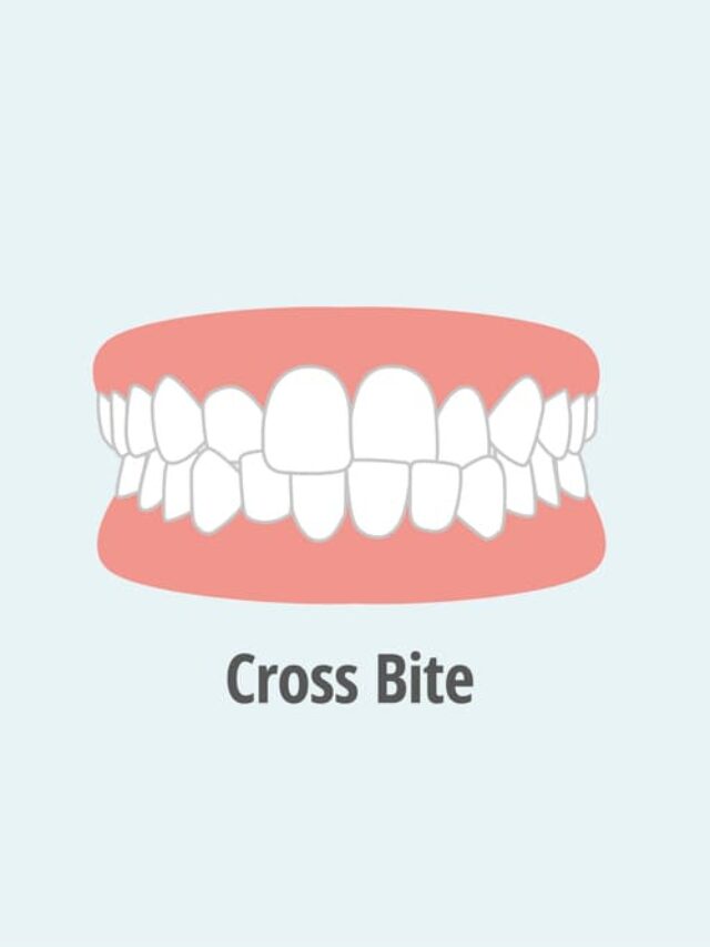 How To Fix a Crossbite Causes and Treatment