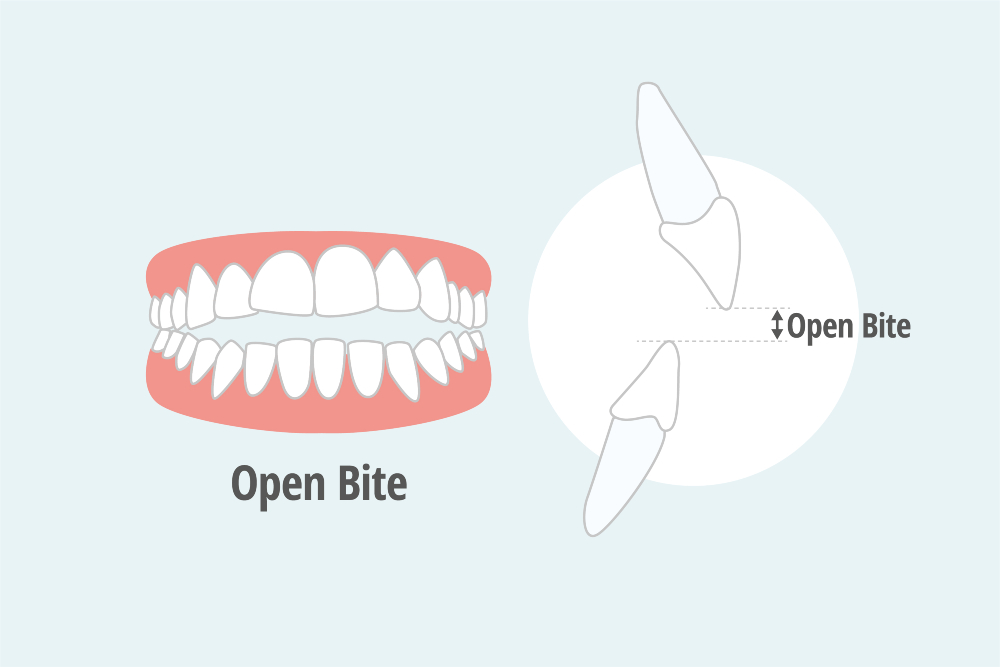 open bite vector image