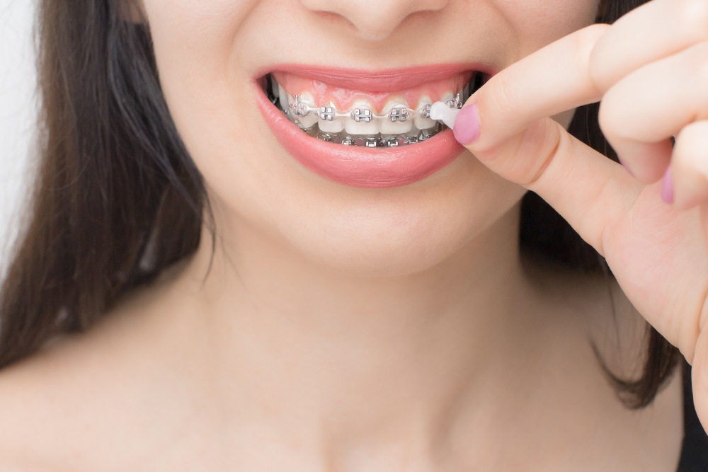 girl with braces applying wax on braces