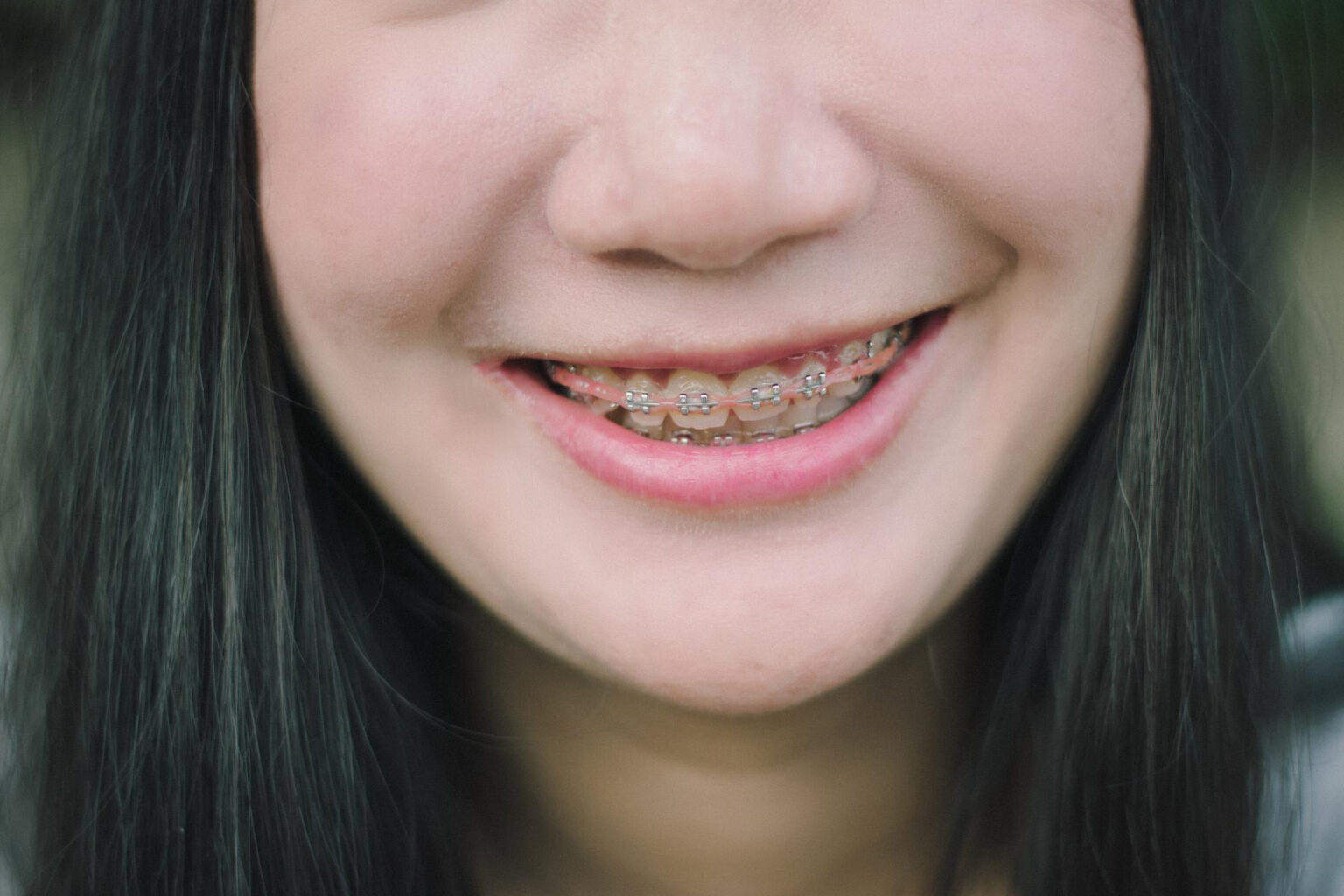 Power Chain Braces Benefits Side Effects Types power-chain-braces-benefits-side-effects-types