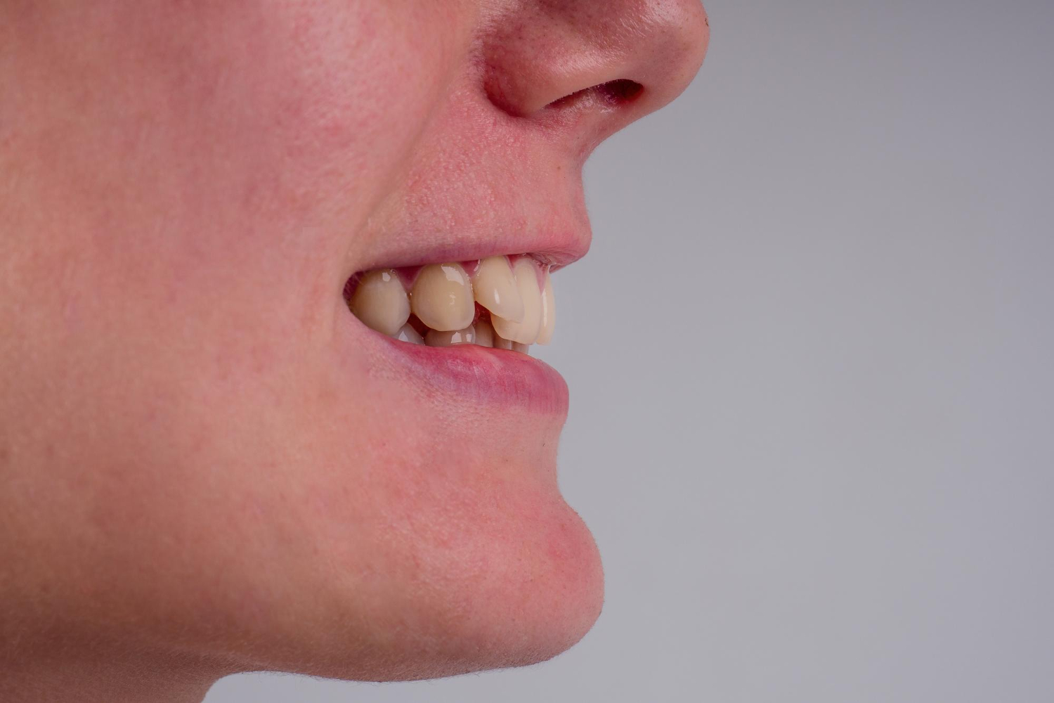 Deep bite